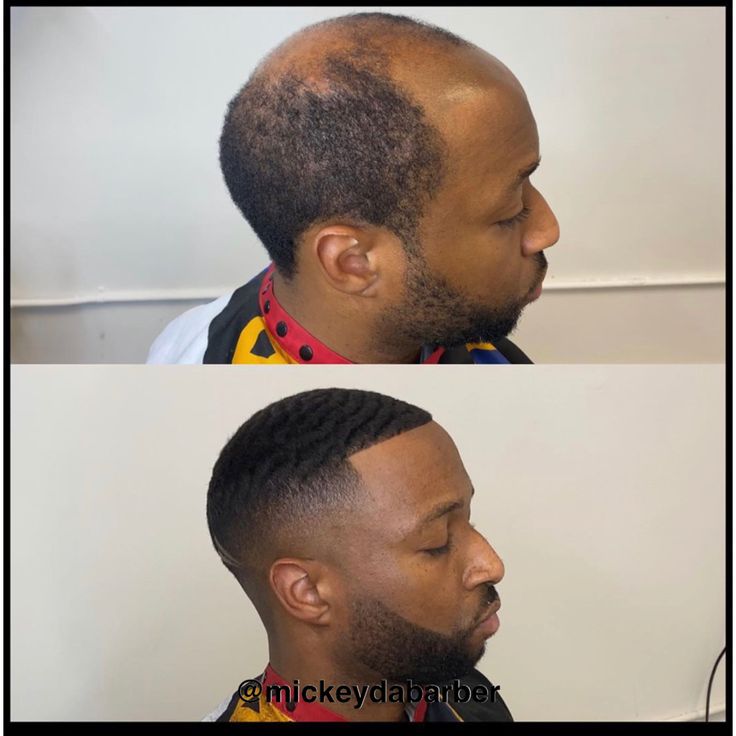 Minoxi 5 Hair Growth Treatment