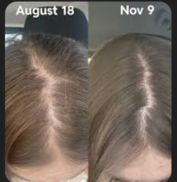 Minoxi 5 Hair Growth Treatment