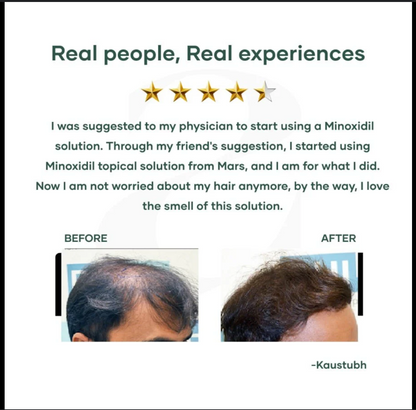 Minoxi 5 Hair Growth Treatment