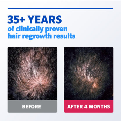 Minoxi 5 Hair Growth Treatment